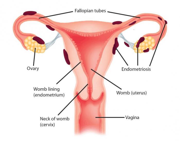 różnica między endometriozą a adenomiozą