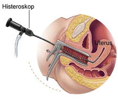 Hysteroresektoskopia - co to jest? Minimalnie inwazyjna metoda leczenia chorób ginekologicznych