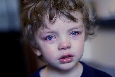 Czerwone oczy u dziecka: przyczyny, leczenie i zapobieganie