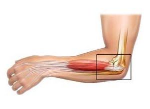 łokciowe zapalenie nadkłykcia