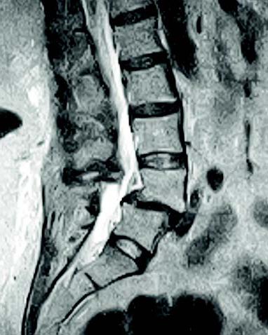 osteofity szyjnego odcinka kręgosłupa 