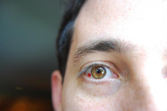 Dlaczego oczy rozrywają naczynia krwionośne: przyczyny i leczenie