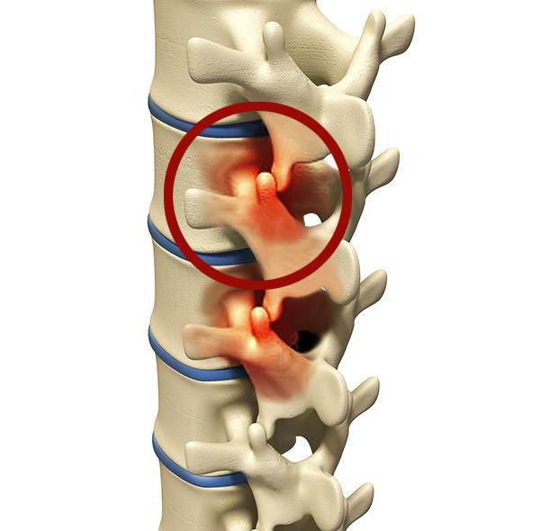 spondyloarthrosis kręgosłupa lędźwiowo-krzyżowego