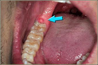 Usunięcie korzenia zęba jest skomplikowaną, ale najbardziej bezbolesną procedurą