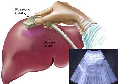 USG wątroby: przygotowanie do zabiegu, wskazania