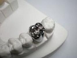 Metalowe korony zębów